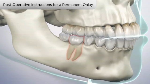 Post-Operative Instructions for Permanent Onlay - Dental Patient Education Video