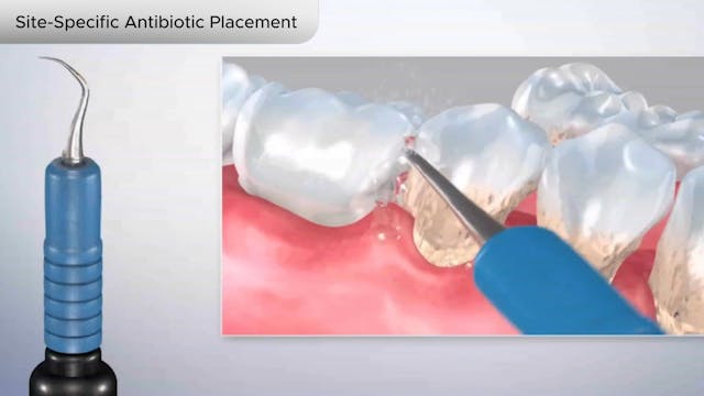 Site-Specific Antibiotic Placement - Dental Patient Education Video