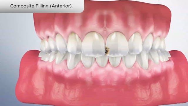 Composite Filling (Anterior) - Dental Patient Education Video