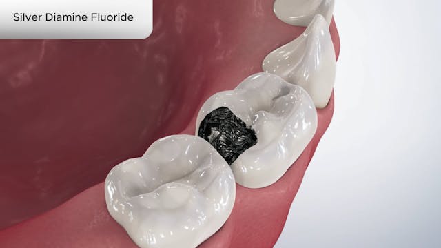 Silver Diamine Fluoride - Dental Patient Education Video