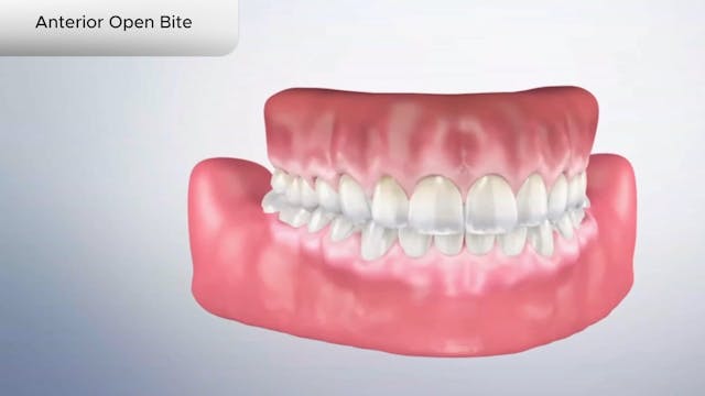 Anterior Open Bite - Dental Patient Education Video