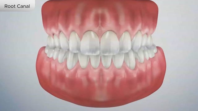 Root Canal - Dental Patient Education Video