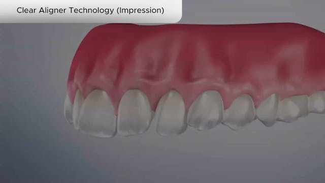 Clear Aligner Technology (Impression) - Dental Patient Education Video