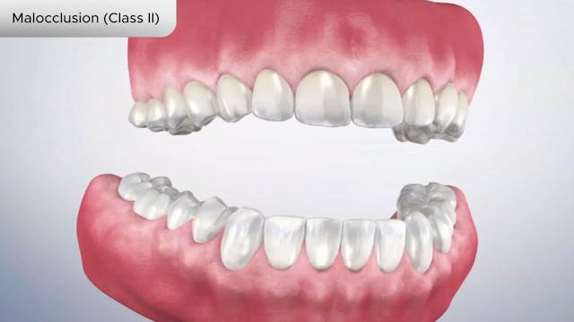 Malocclusion (Class II) - Dental Patient Education Video