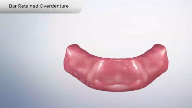 Bar Retained Overdenture - Dental Patient Education Video