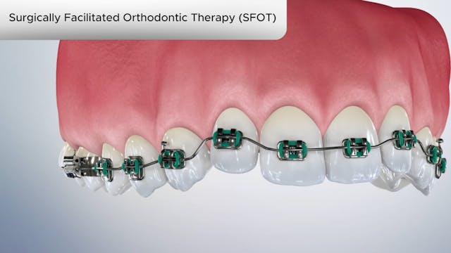 Surgically Facilitated Orthodontic Therapy (SFOT)-Dental Patient Education Video