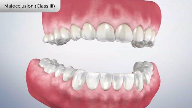 Malocclusion (Class III) - Dental Patient Education Video