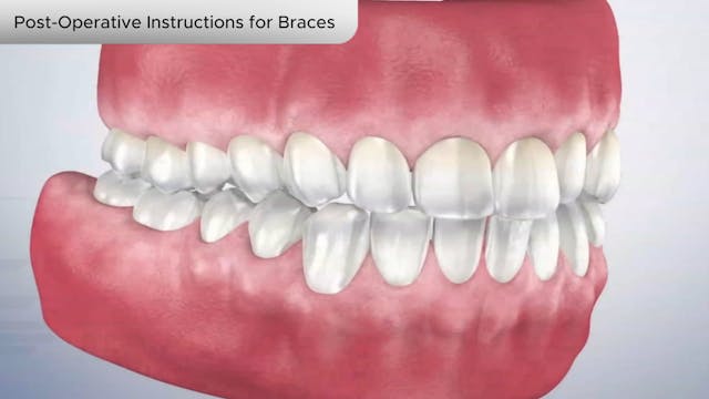 Post-Operative Instructions for Braces - Dental Patient Education Video