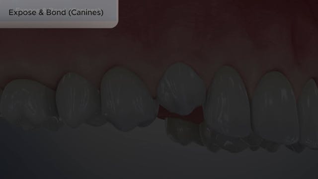 Expose & Bond (Canines) - Dental Patient Education Video