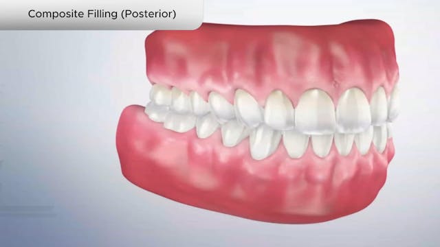 Composite Filling (Posterior) - Dental Patient Education Video