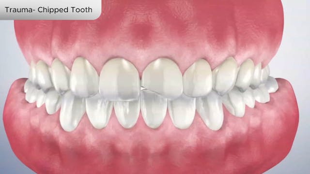 Trauma- Chipped Tooth - Dental Patient Education Video