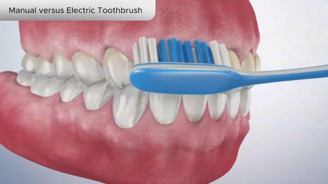 Manual versus Electric Toothbrush - Dental Patient Education Video