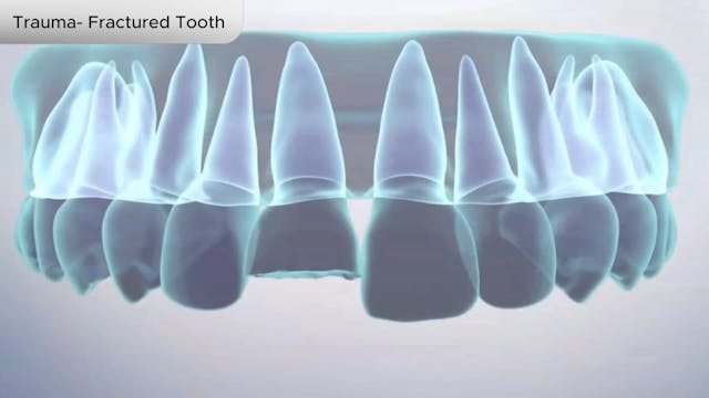 Trauma- Fractured Tooth - Dental Patient Education Video