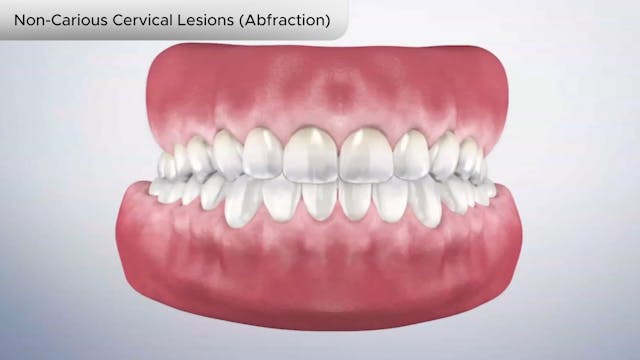 Non-Carious Cervical Lesions (Abfraction) - Dental Patient Education Video