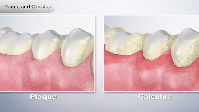 Plaque and Calculus - Dental Patient Education Video