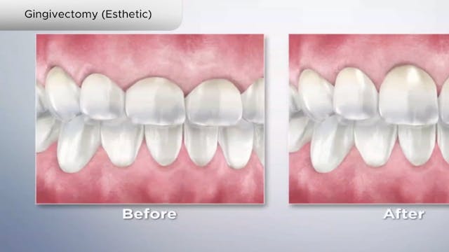 Gingivectomy (Esthetic) - Dental Patient Education Video