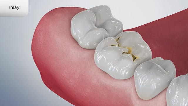 Inlay - Dental Patient Education Video