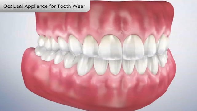 Occlusal Appliance for Tooth Wear - Dental Patient Education Video