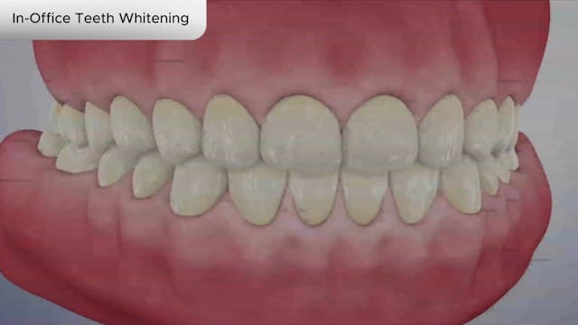 In-Office Teeth Whitening - Dental Patient Education Video