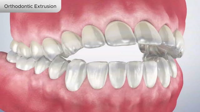 Orthodontic Extrusion - Dental Patient Education Video