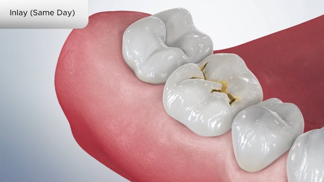 Inlay (Same Day) - Dental Patient Education Video