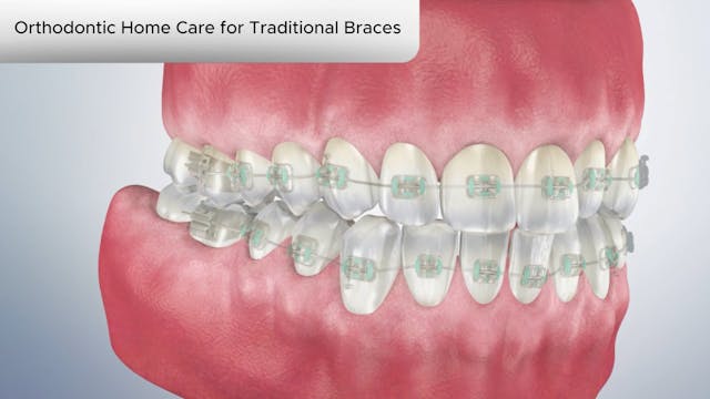 Orthodontic Home Care for Traditional Braces - Dental Patient Education Video