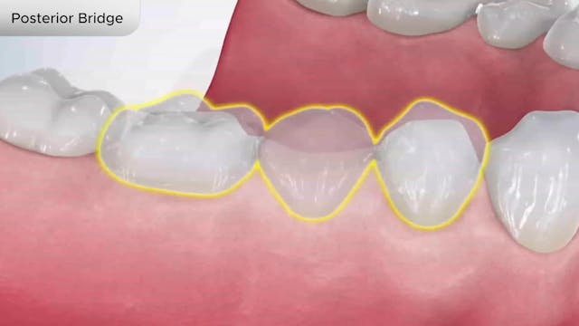 Posterior Bridge - Dental Patient Education Video