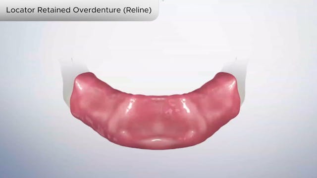 Locator Retained Overdenture (Reline) - Dental Patient Education Video