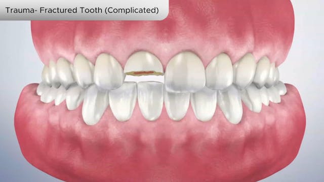 Trauma- Fractured Tooth (Complicated) - Dental Patient Education Video