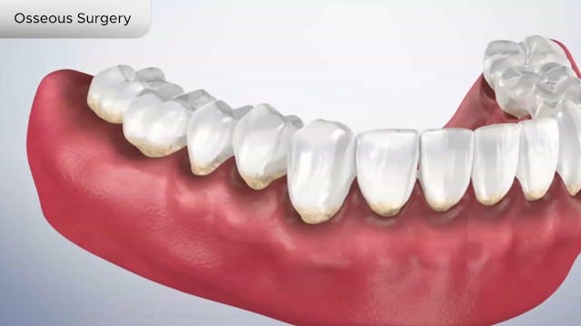 Osseous Surgery - Dental Patient Education Video