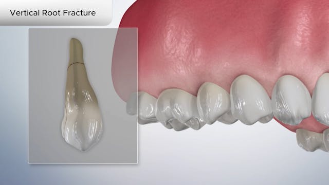 Vertical Root Fracture - Dental Patient Education Video