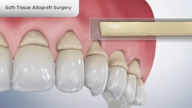 Soft-Tissue Allograft Surgery - Dental Patient Education Video