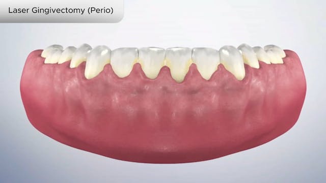 Laser Gingivectomy (Perio) - Dental Patient Education Video