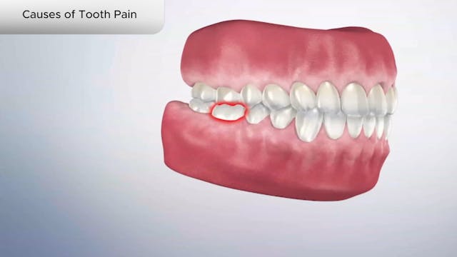 Causes of Tooth Pain - Dental Patient Education Video