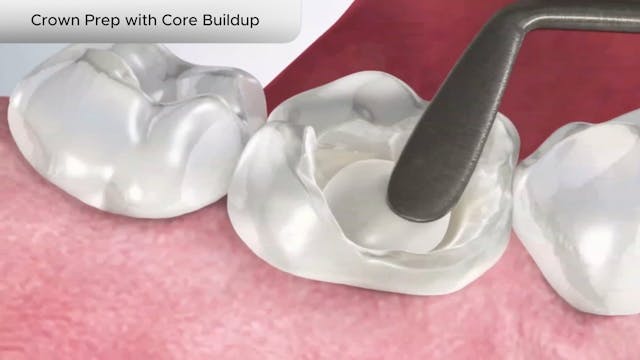 Crown Prep with Core Buildup - Dental Patient Education Video