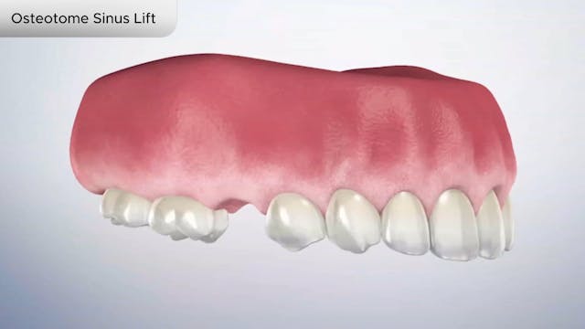 Osteotome Sinus Lift - Dental Patient Education Video