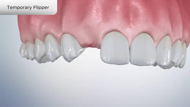 Temporary Flipper - Dental Patient Education Video