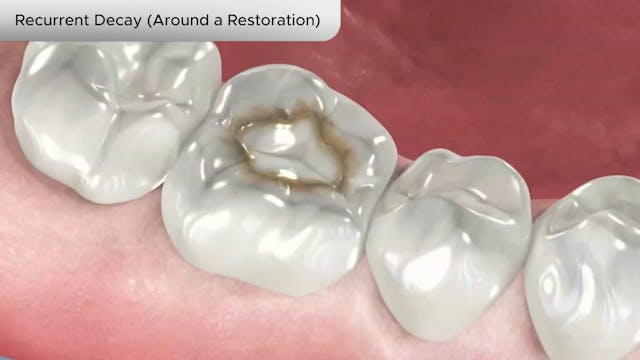 Recurrent Decay (Around a Restoration) - Dental Patient Education Video