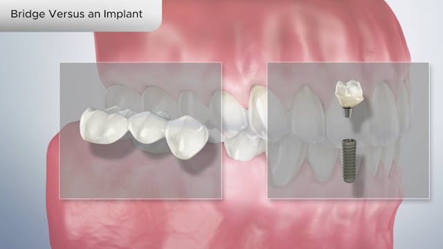 Bridge Versus an Implant - Dental Patient Education Video