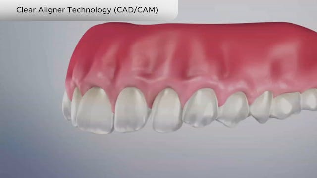 Clear Aligner Technology (CADCAM) - Dental Patient Education Video