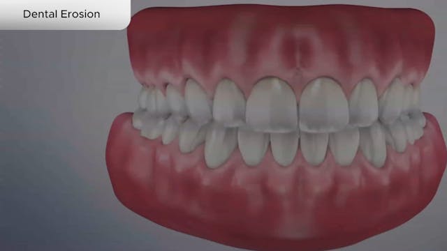 Dental Erosion - Dental Patient Education Video