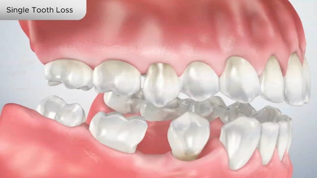 Single Tooth Loss - Dental Patient Education Video