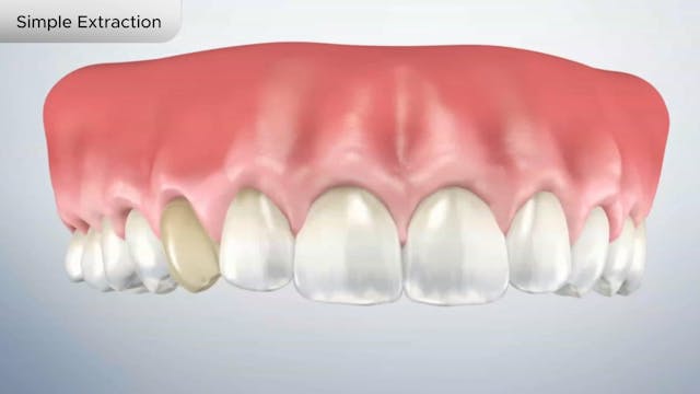 Simple Extraction - Dental Patient Education Video