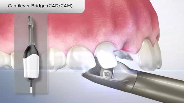 Cantilever Bridge (CADCAM) - Dental Patient Education Video