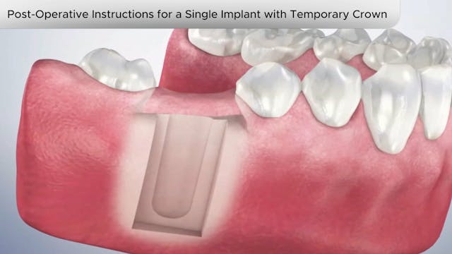 PostOperative Ins Single Implant Temporary Crown Dental Patient Education Video