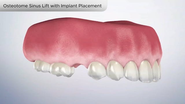 Osteotome Sinus Lift with Implant Placement - Dental Patient Education Video