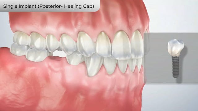 Single Implant (Posterior- Healing Cap) - Dental Patient Education Video