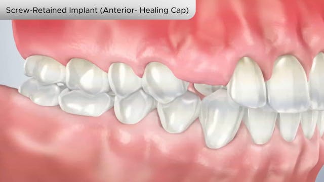 Screw-Retained Implant (Anterior- Healing Cap) - Dental Patient Education Video