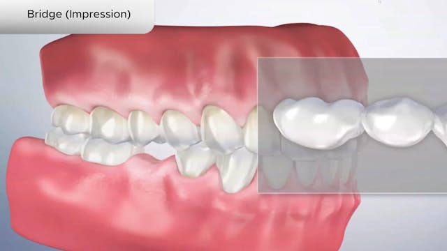 Bridge (Impression) - Dental Patient Education Video