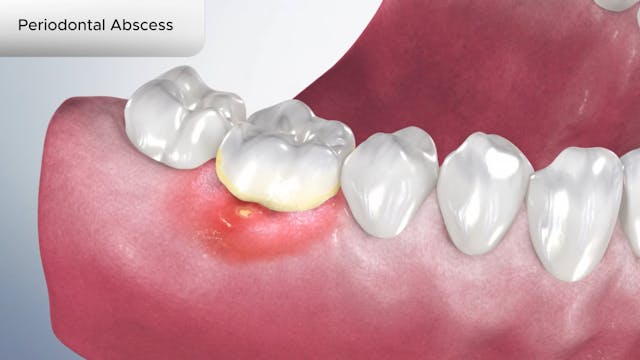 Periodontal Abscess - Dental Patient Education Video